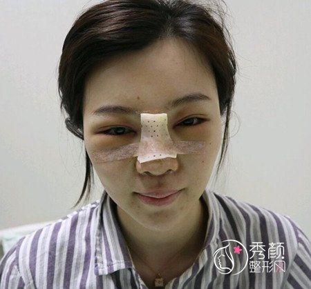 武汉刘波50000人民币做的肋骨鼻子,恢复好了各种开心。