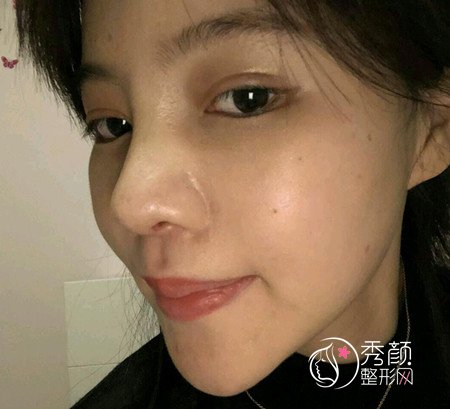 武汉刘波50000人民币做的肋骨鼻子,恢复好了各种开心。