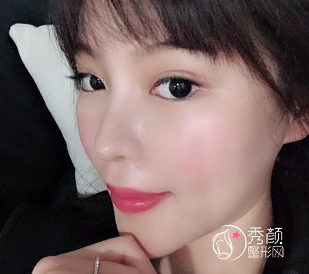 武汉刘波50000人民币做的肋骨鼻子,恢复好了各种开心。