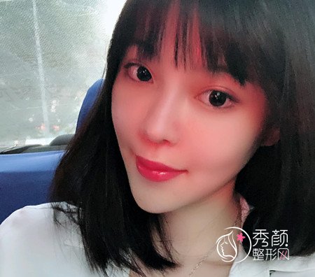 武汉刘波50000人民币做的肋骨鼻子,恢复好了各种开心。