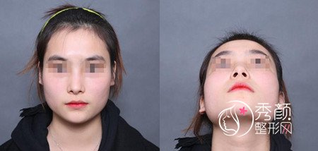 黄大勇磨骨好不好,看看我花48000黄大勇做的下颌角手术。