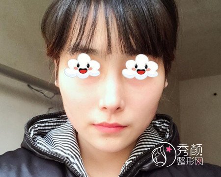 黄大勇磨骨好不好,看看我花48000黄大勇做的下颌角手术。