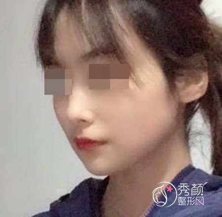 黄大勇磨骨好不好,看看我花48000黄大勇做的下颌角手术。