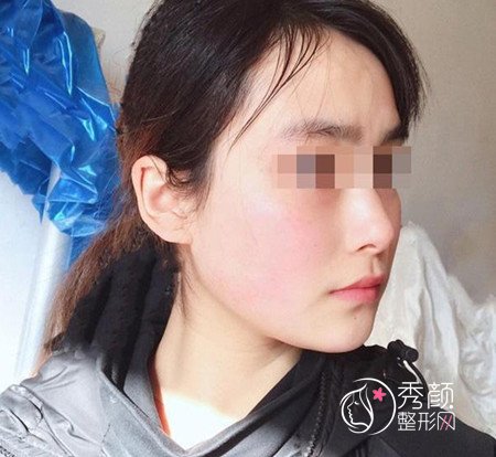 黄大勇磨骨好不好,看看我花48000黄大勇做的下颌角手术。