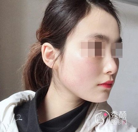 黄大勇磨骨好不好,看看我花48000黄大勇做的下颌角手术。