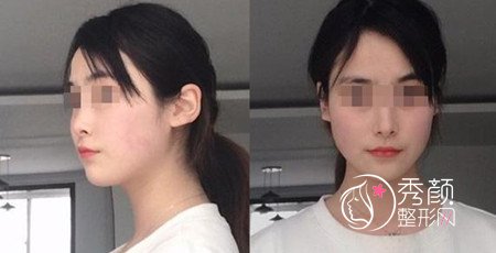 黄大勇磨骨好不好,看看我花48000黄大勇做的下颌角手术。