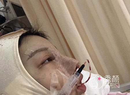 上海伯思立李茂群做的肋软骨鼻子,大家看看怎么样。