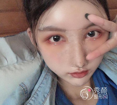 上海伯思立李茂群做的肋软骨鼻子,大家看看怎么样。