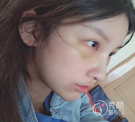 上海伯思立李茂群做的肋软骨鼻子,大家看看怎么样。