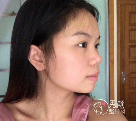 上海九院濮哲铭硅胶垫下巴,花了8000多下巴终于好看了。