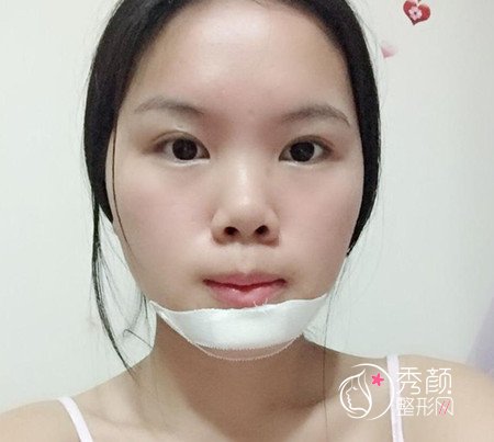 上海九院濮哲铭硅胶垫下巴,花了8000多下巴终于好看了。