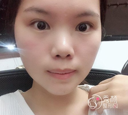 上海九院濮哲铭硅胶垫下巴,花了8000多下巴终于好看了。