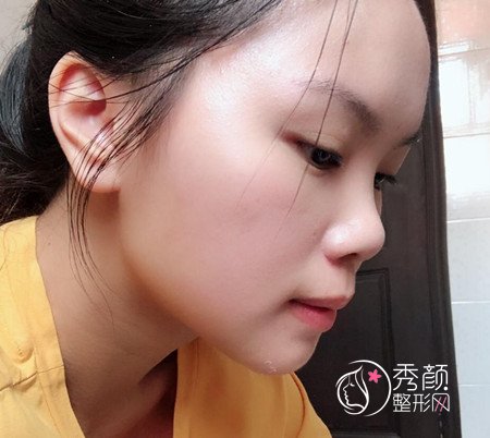 上海九院濮哲铭硅胶垫下巴,花了8000多下巴终于好看了。