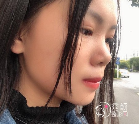 上海九院濮哲铭硅胶垫下巴,花了8000多下巴终于好看了。