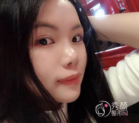 上海九院濮哲铭硅胶垫下巴,花了8000多下巴终于好看了。