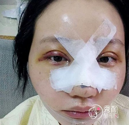 【整形日记】我在上海容妍国际做眼鼻部手术的130天分享