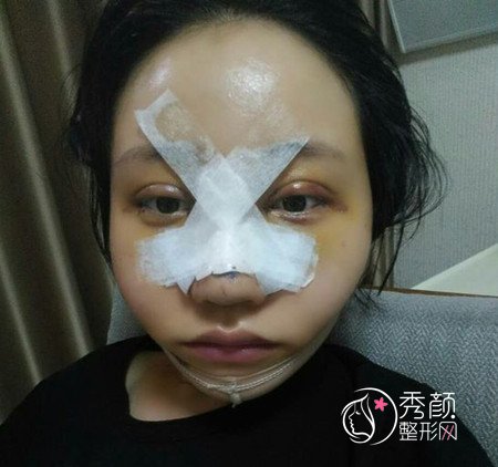 【整形日记】我在上海容妍国际做眼鼻部手术的130天分享
