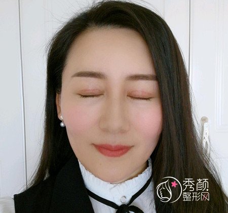 上海九院刘菲双眼皮修复案例分享。