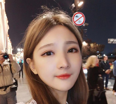 上海华美李志海下颌角切除+颧骨内推术前术后案例对比分享。
