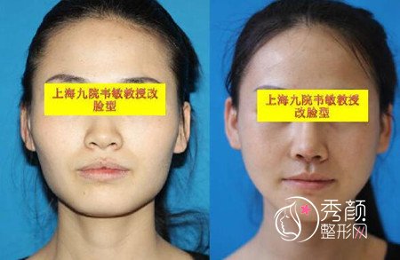 上海九院韦敏磨骨改脸型案例（术前术后对比图）
