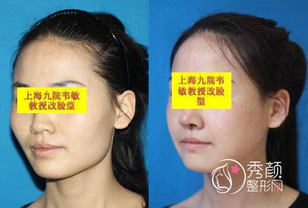 上海九院韦敏磨骨改脸型案例（术前术后对比图）