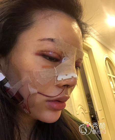 上海伊莱美李湘原割双眼皮+肋软骨隆鼻术前术后案例分享。