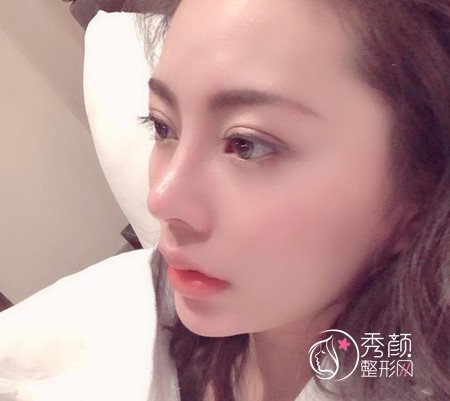 上海伊莱美李湘原割双眼皮+肋软骨隆鼻术前术后案例分享。