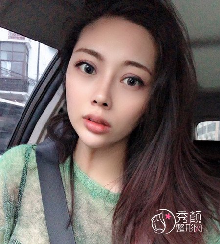 上海伊莱美李湘原割双眼皮+肋软骨隆鼻术前术后案例分享。