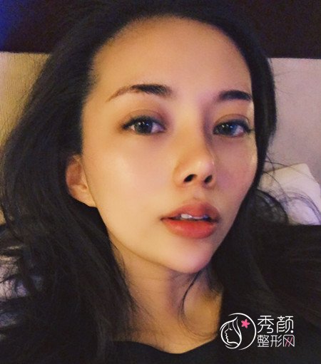 上海伊莱美李湘原割双眼皮+肋软骨隆鼻术前术后案例分享。