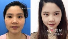 <b>上海九院韦敏、袁捷、柴岗、徐梁磨骨谁好,价格案例分析对比。</b>