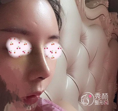 北京八大处王欢鼻修复案例。