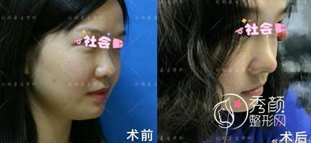 八大处刘暾隆鼻怎么样,刘暾鼻部手术案例。