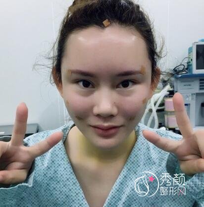 南京公立医院做的，我做自体脂肪填充全脸的经验