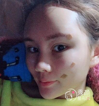 南京公立医院做的,我做自体脂肪填充全脸的经验