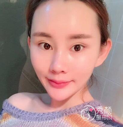 南京公立医院做的,我做自体脂肪填充全脸的经验