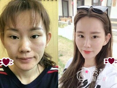 南京公立医院做的,我做自体脂肪填充全脸的经验