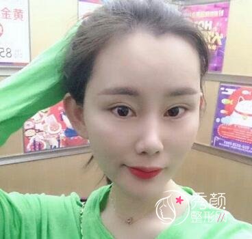 南京公立医院做的,我做自体脂肪填充全脸的经验