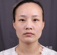 <b>李志海磨骨怎么样 下颌角整形案例 颧骨内推案例</b>