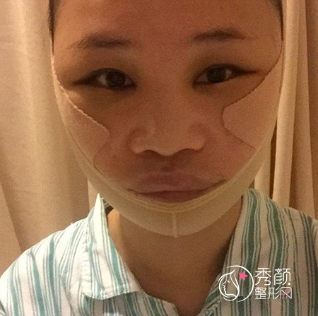 李志海磨骨怎么样 下颌角整形案例 颧骨内推案例