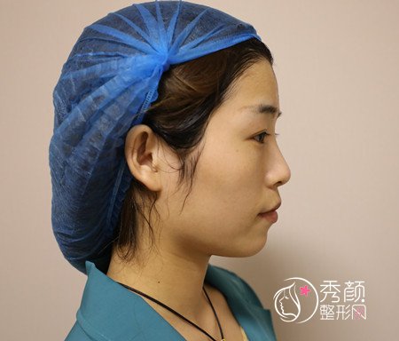 我在郑州丽天罗明生那儿做的全脸自体脂肪填充案例分享。