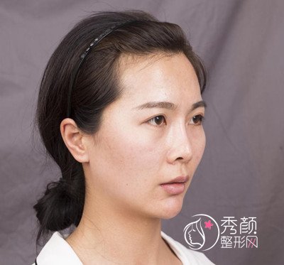 上海华美李健鼻部手术+全脸自体脂肪填充案例。