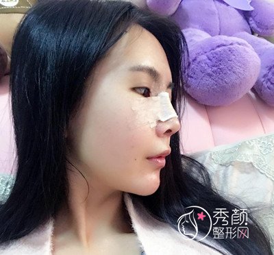 上海华美李健鼻部手术+全脸自体脂肪填充案例。