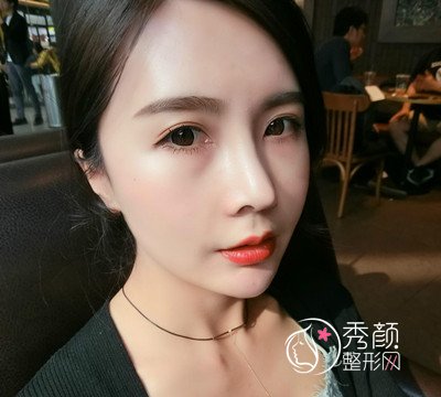 上海华美李健鼻部手术+全脸自体脂肪填充案例。