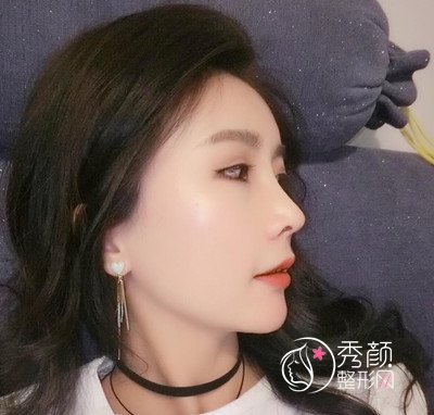 上海华美李健鼻部手术+全脸自体脂肪填充案例。