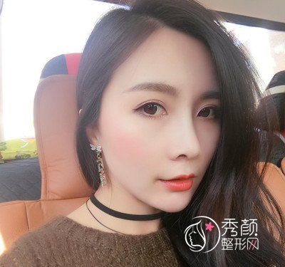 上海华美李健鼻部手术+全脸自体脂肪填充案例。