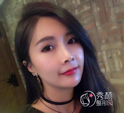 上海华美李健鼻部手术+全脸自体脂肪填充案例。