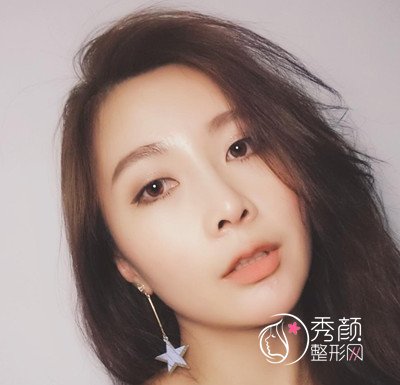 上海华美李健鼻部手术+全脸自体脂肪填充案例。