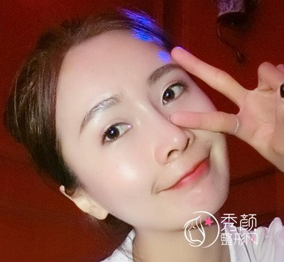 上海华美李健鼻部手术+全脸自体脂肪填充案例。