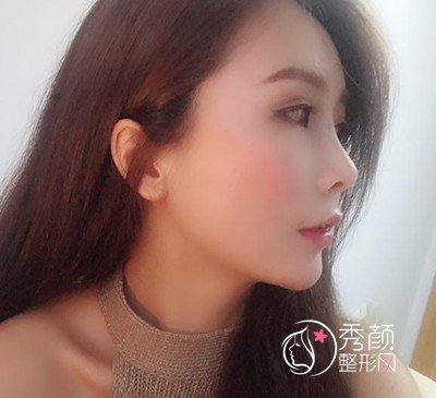 上海华美李健鼻部手术+全脸自体脂肪填充案例。