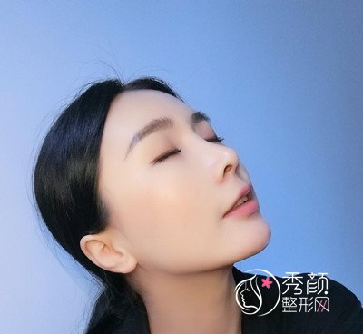 上海华美李健鼻部手术+全脸自体脂肪填充案例。